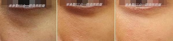 三合一眼袋黑眼圈