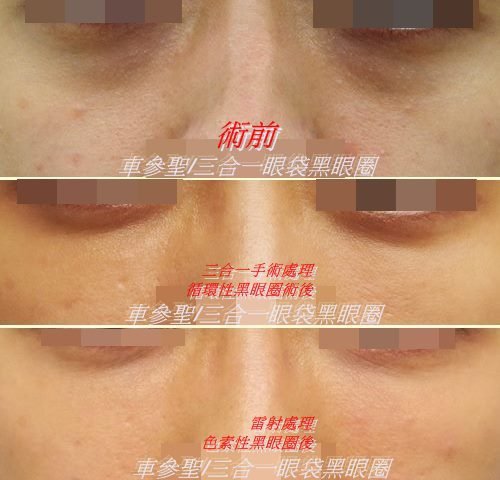三合一眼袋黑眼圈