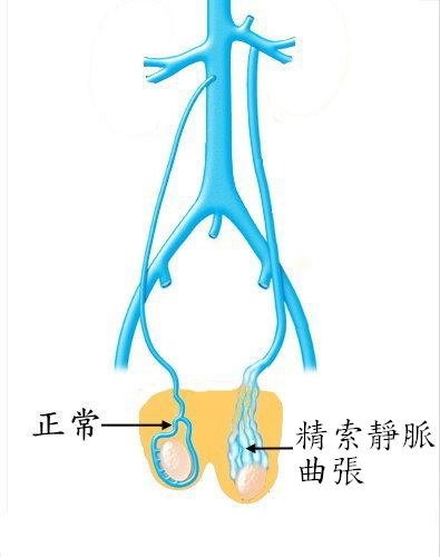 精索靜脈曲張示意圖