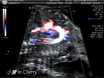 aortic arch
