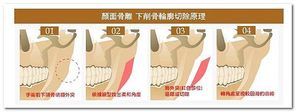 顏面下削骨切除原理│台中群英整形