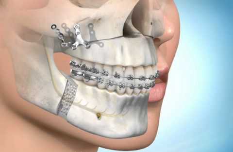 fig 2 2 jaws surgery