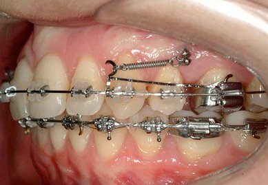 anterior teeth retraction with minis crews