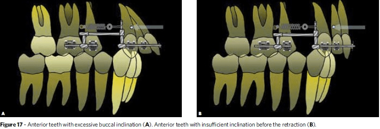 dental protrusion or bone protrusion