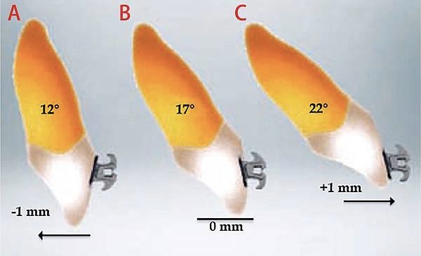 fig 3anterior teeth torque