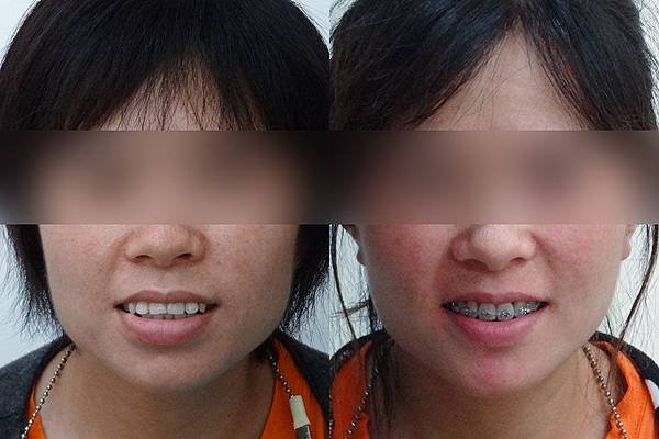 圖三 before and after front view