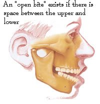 fig 2. oral_surgeon_open-bite-1