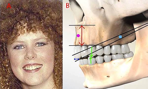 gingival exposed while smiling explainedˍ2