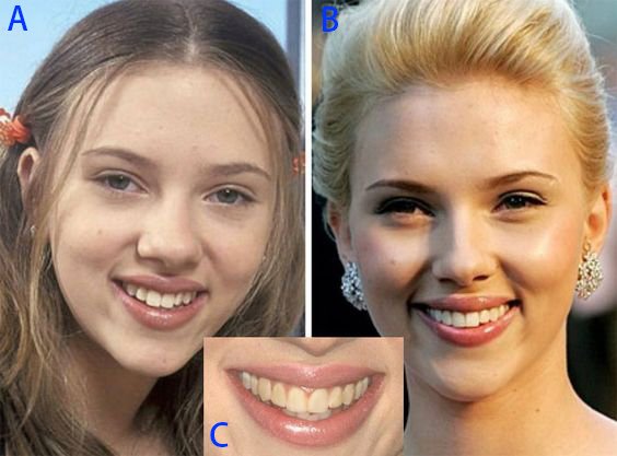 圖二Scarlett Johansson teeth change with ABC