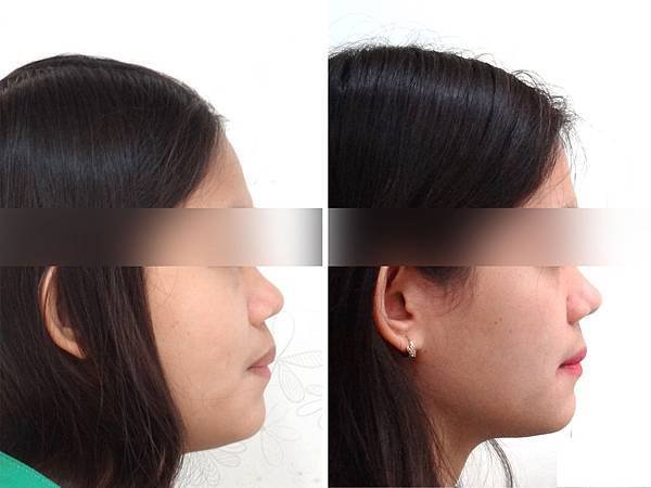 圖六班卡before and after lateral profile change