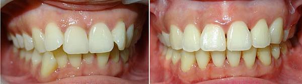 圖七班卡矯正前與矯正後正面咬合照片
