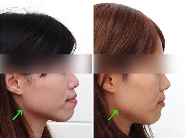 圖九翁淑真lateral profile before and during braces