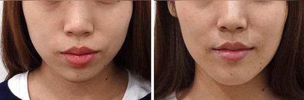 圖六鄒沂芬before and after frontal view eye covering