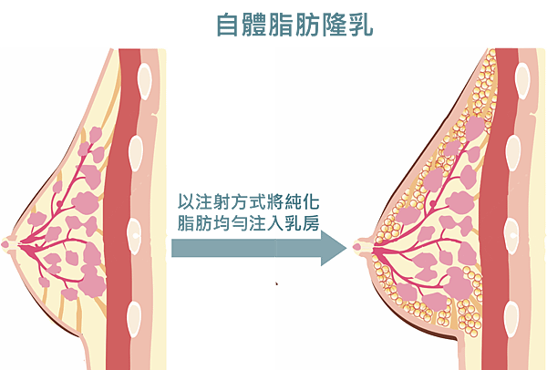 台北隆乳女醫推薦,自體脂肪隆乳方式