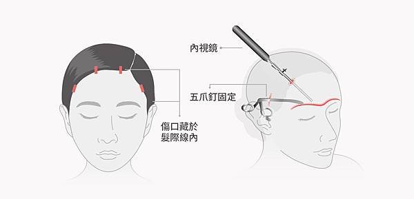 晶華醫美的隱痕提眉手術，術前無須剃髮，術後也無需引流管