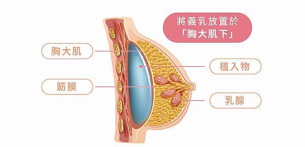 晶華醫美透過內視鏡進行女王波隆乳手術，術後傷口微創、近乎隱痕。