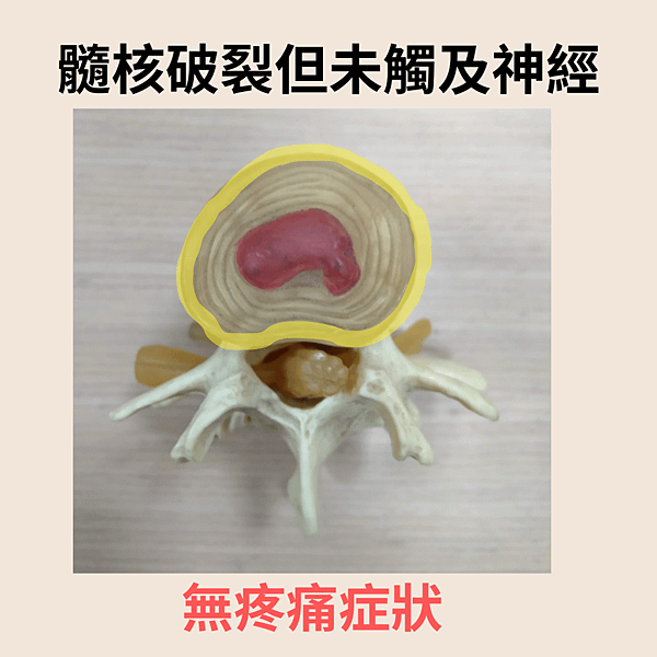 髓核 (1).png