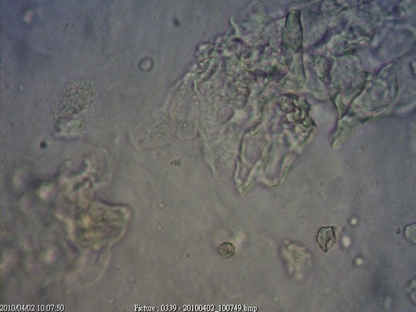 20100331上皮細胞白血球細菌(不同層次).jpg