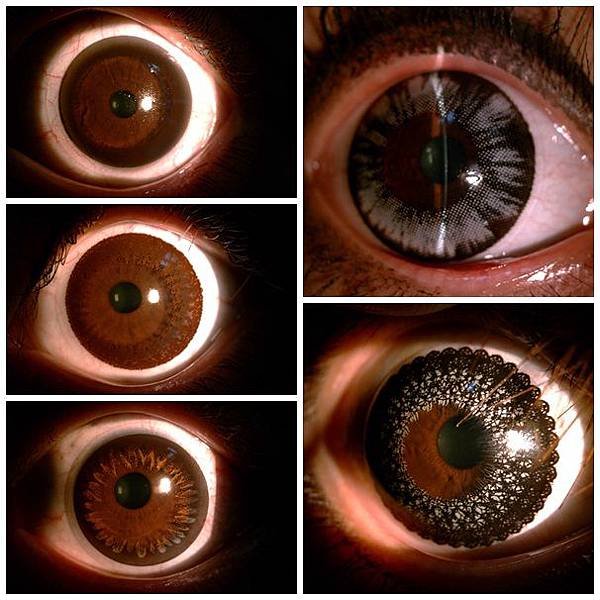 contact lens