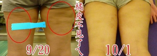 橘皮和妊成紋 (11).jpg