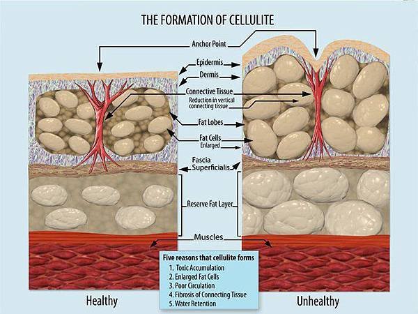 Formation_of_Cellulite.jpg