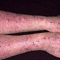 eczema