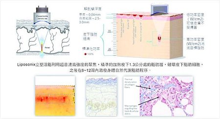 Liposonix文案6.jpg