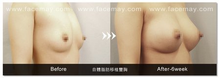 威塑抽脂自體脂肪隆乳