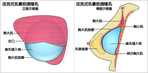 05筋膜隆乳