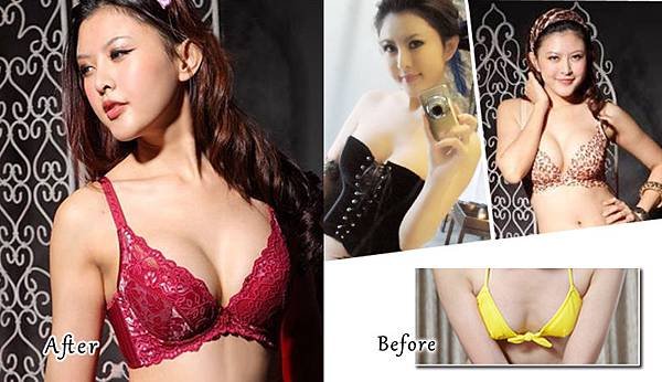 台中果凍矽膠隆乳＋自體脂肪豐胸｜台中菲仕美