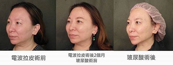 台中玻尿酸拉提｜台中玻尿酸微整｜菲仕美診所