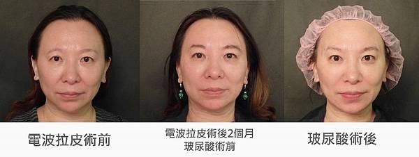 台中玻尿酸拉提｜台中玻尿酸微整｜菲仕美診所