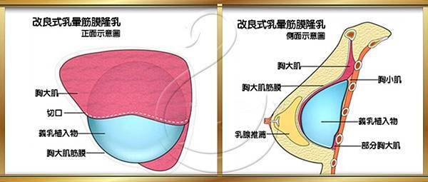 台中隆乳手術方式|隆乳權威推薦｜菲仕美診所