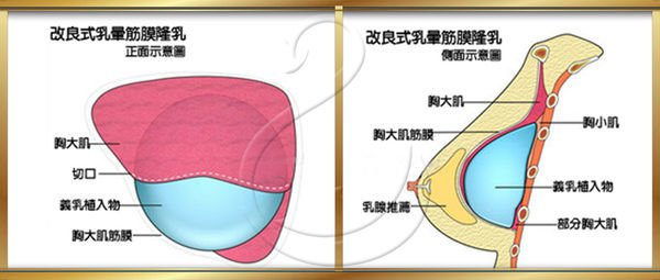 台中隆乳手術｜台中隆乳權威｜菲仕美