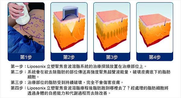 liposonix立塑聚焦音波溶脂價錢