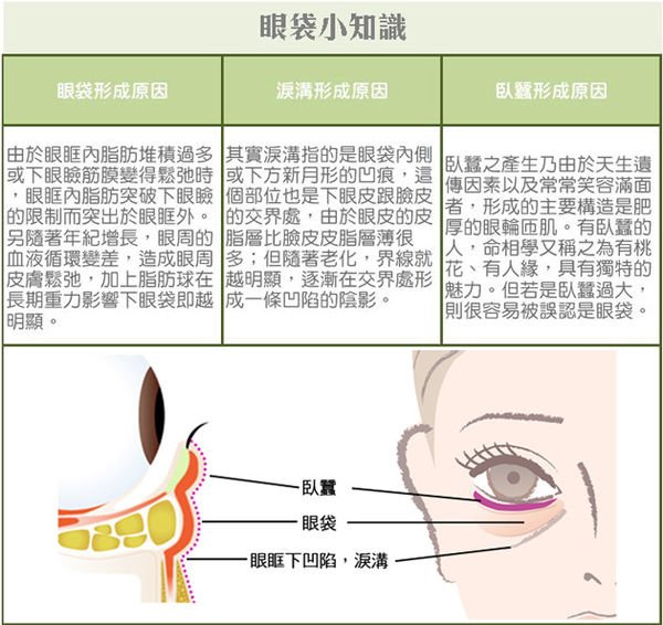 台中眼袋外開,台中眼袋外開手術,台中眼袋外開疤痕,台中眼袋外開權威,台中眼袋外開推薦,台中眼袋手術權威,台中割眼袋名醫,外開眼袋照片,消除眼袋手術費用,台中眼袋手術費用,台中去除眼袋,台中眼袋,台中眼袋推薦