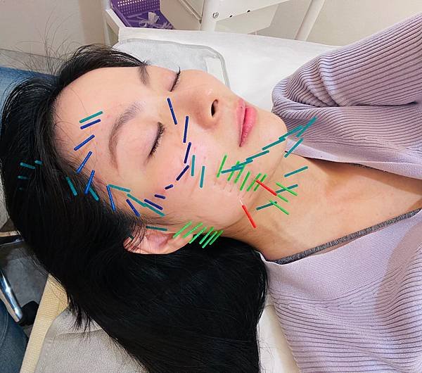 台北美顏針醫師推薦承新中醫許舒嵐醫師｜分享我超有感的針灸經驗