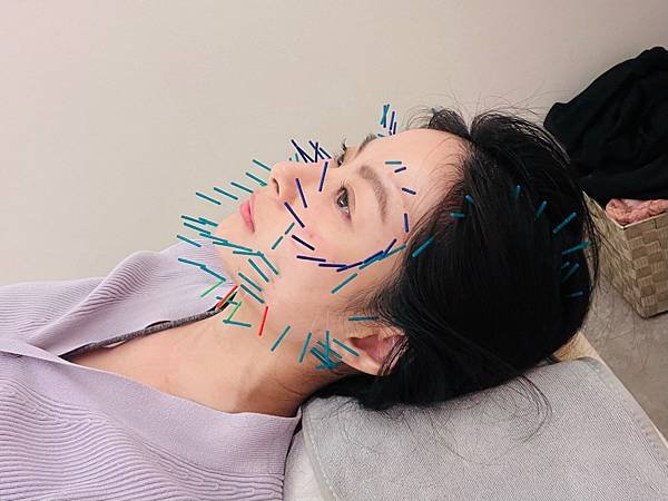台北美顏針醫師推薦承新中醫許舒嵐醫師｜分享我超有感的針灸經驗