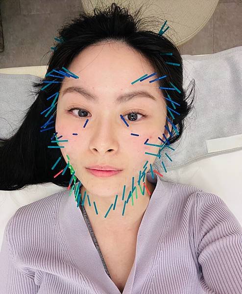 台北美顏針醫師推薦承新中醫許舒嵐醫師｜分享我超有感的針灸經驗