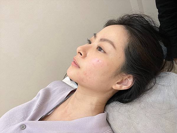 台北美顏針醫師推薦承新中醫許舒嵐醫師｜分享我超有感的針灸經驗