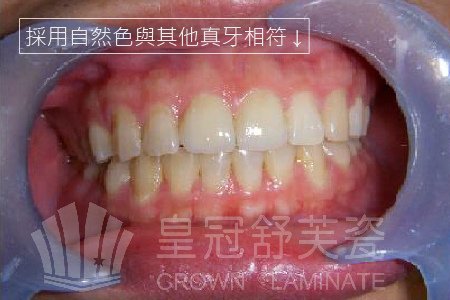 門牙磨耗2-01
