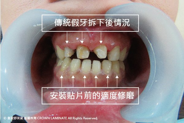 美齒小故事-假牙舊換新+美白-2-01