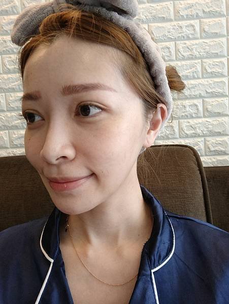 藍鑽魚骨線埋線緊實記錄💕~還妳年輕的秘密~依定美時尚診所