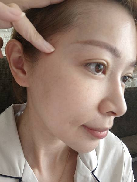 藍鑽魚骨線埋線緊實記錄💕~還妳年輕的秘密~依定美時尚診所
