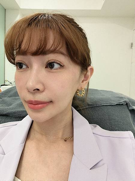 日曦美學診所&gt;&gt;公主玻尿酸讓我重拾年輕自信