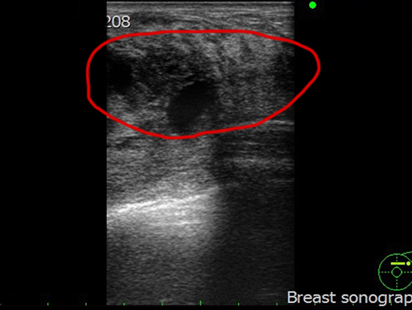 彰化醫院乳房超音波檢查2.png