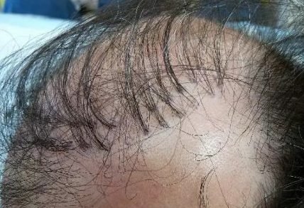 10 Hair-Transplant-Plugs-e1615409901675.jpeg