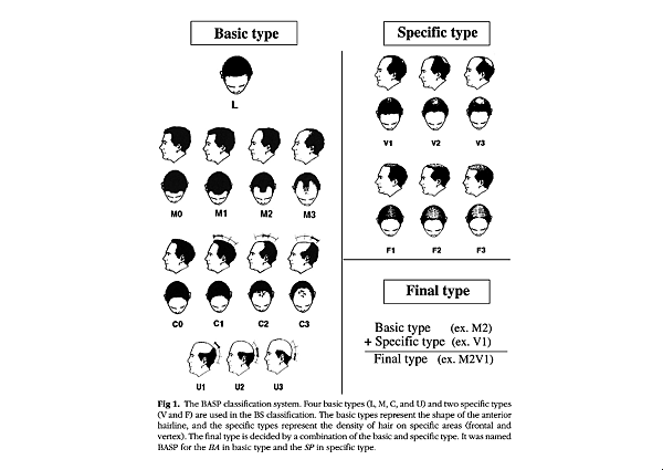 BASP型態性落髮的分期系統.png