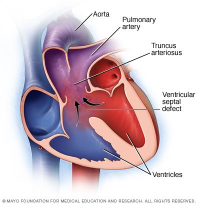 ds00746_ds00998_im00120_hb7_truncus_thu_jpg.png