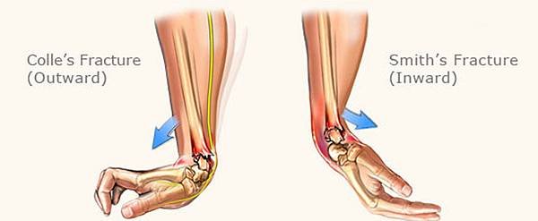 colles-smith-fractures.jpg